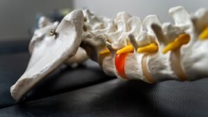 degenerative disc disease michigan