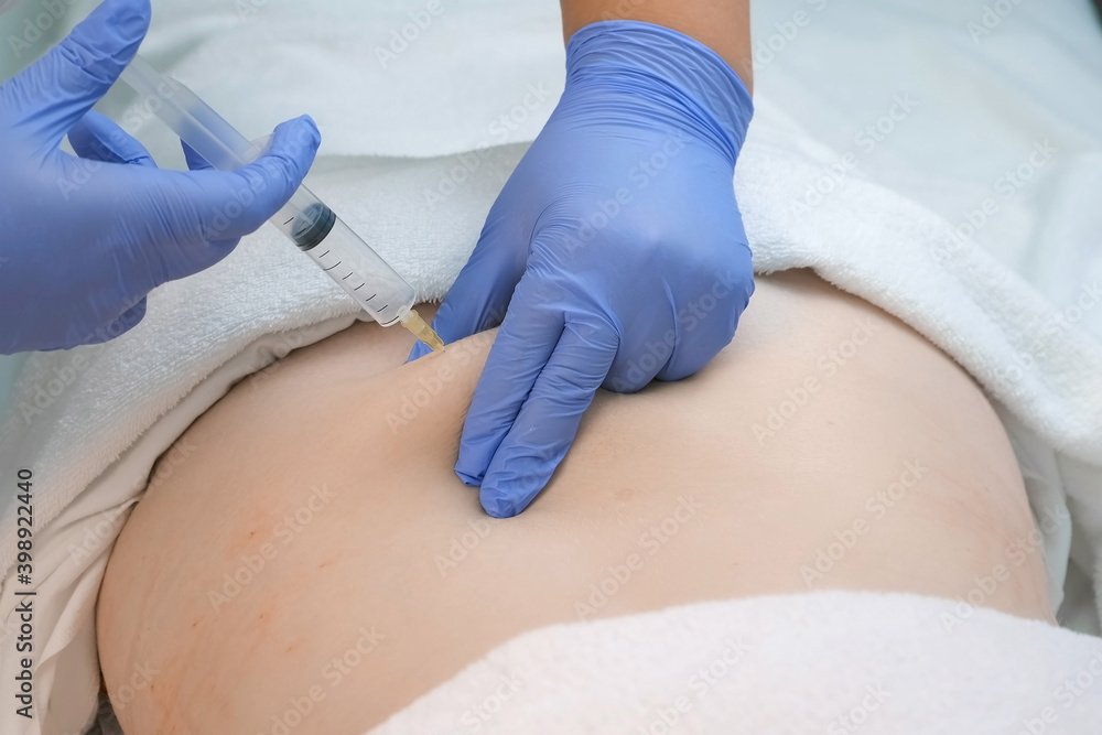 Doctor makes injection of ozone gas in patient's woman back against stretches on ozone therapy, closeup view. Treatment, cure and remove of skin tags and stretches. Cosmetologist woman in gloves.