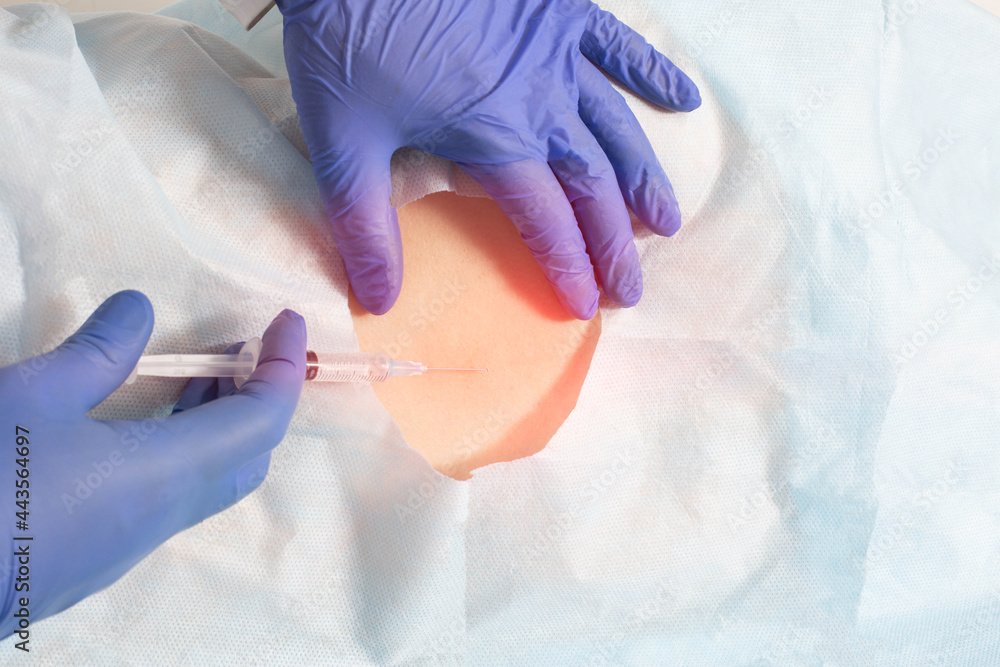 The doctor performs an epidural block on a patient for pain relief during surgery. Type of anesthesia in medicine